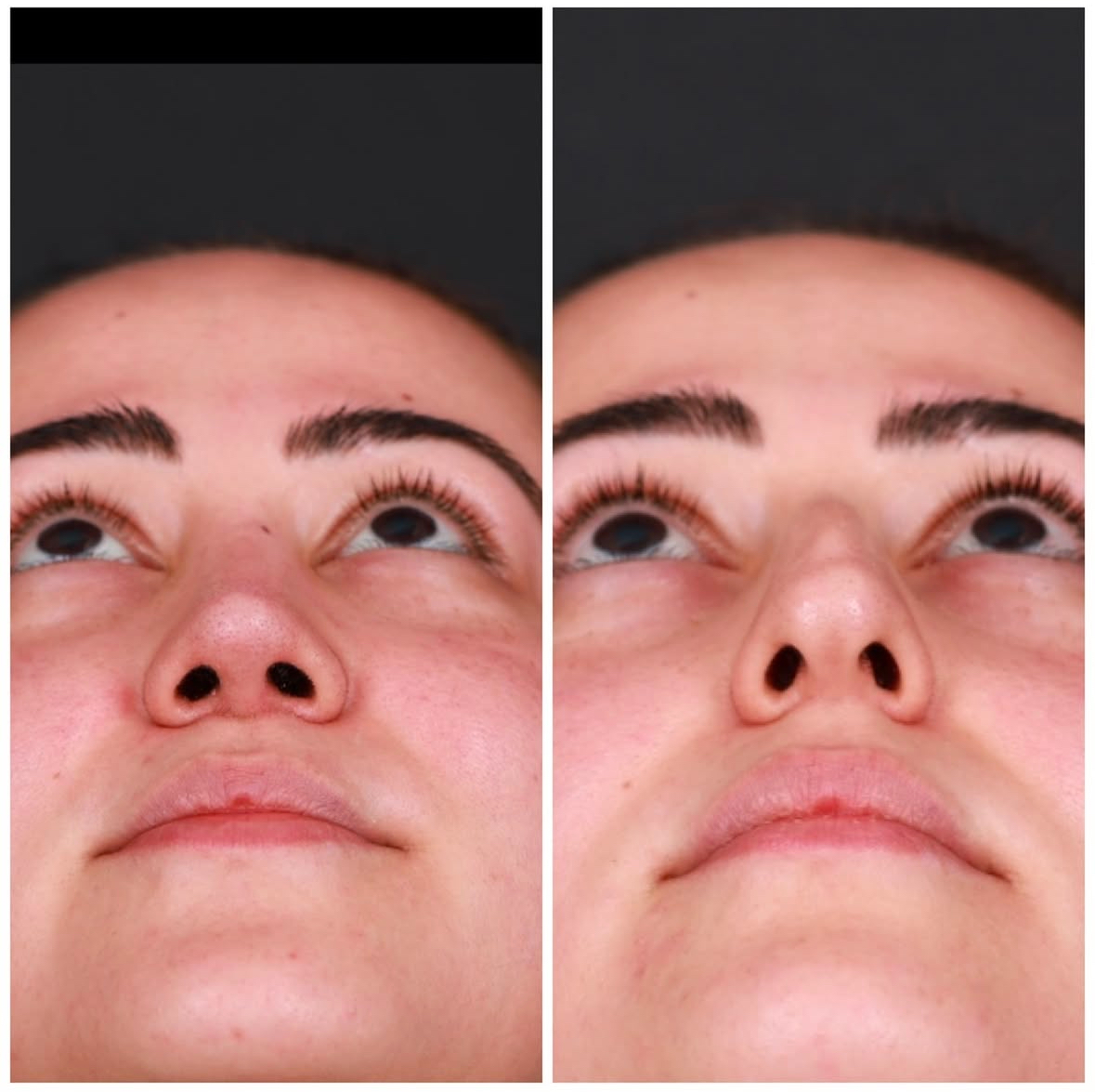 Antalya burun estetiği öncesi sonrası hasta sonucu 1