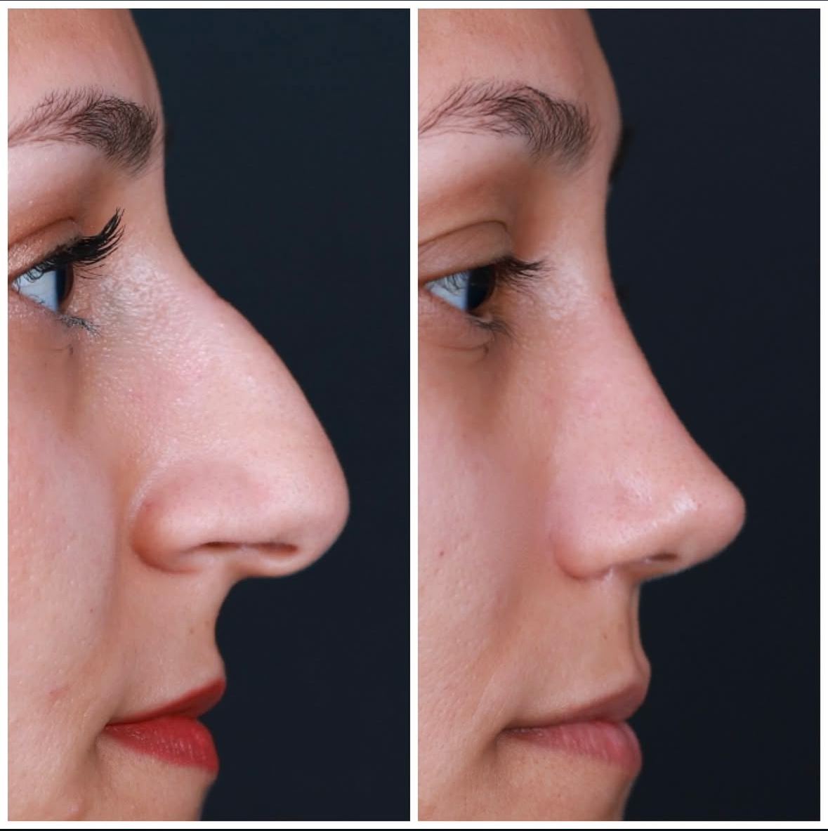 Antalya burun estetiği öncesi sonrası hasta sonucu 2