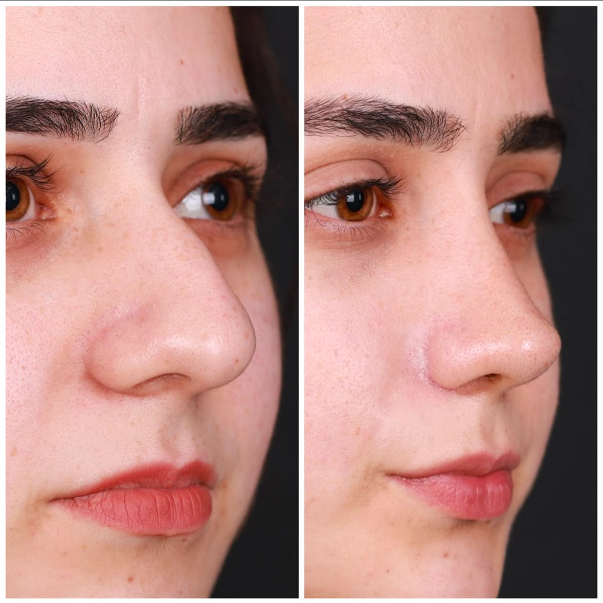 Antalya burun estetiği öncesi sonrası hasta sonucu 4